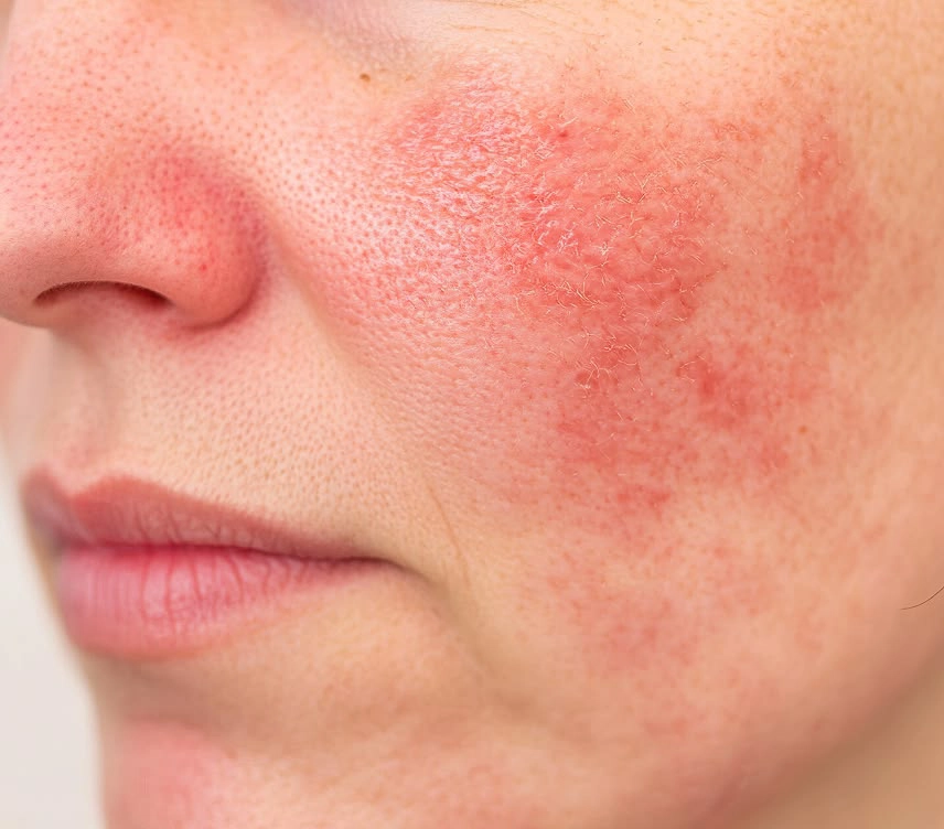 Rosacea Treatment