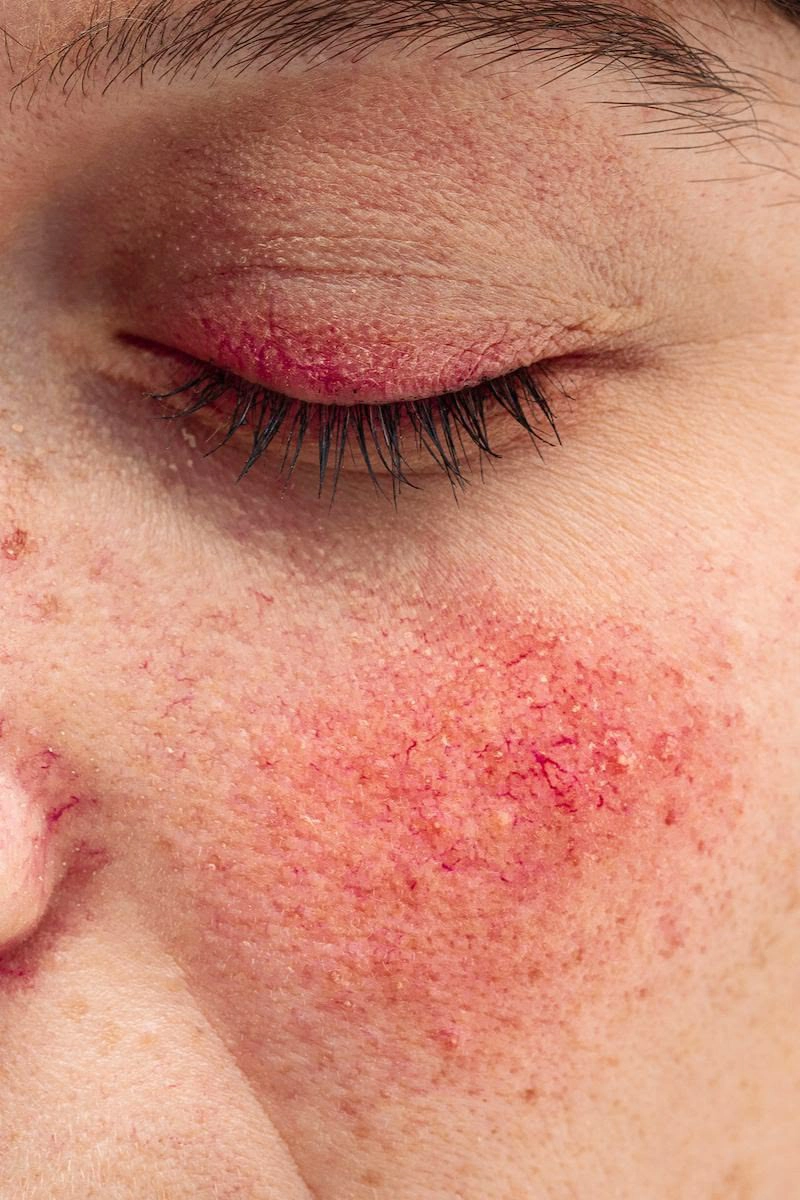 Rosacea Treatment