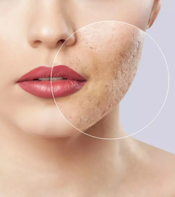 Scar Treatment