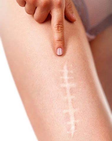 Scar Treatment