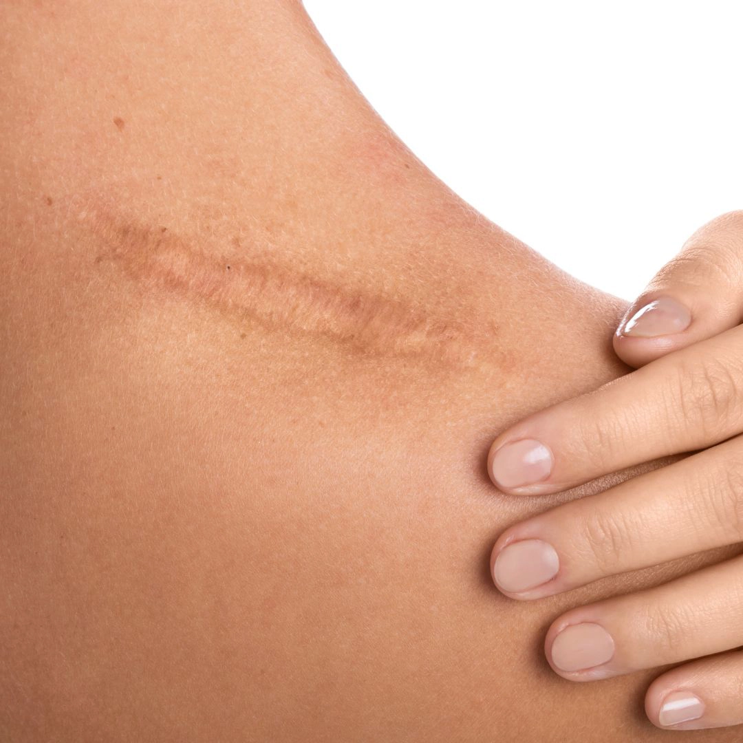Scar Treatment