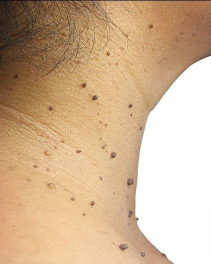 Skin Tag Removal