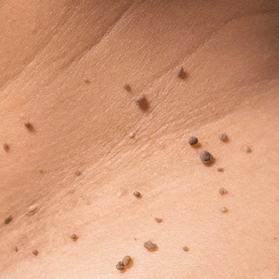 Skin Tag Removal