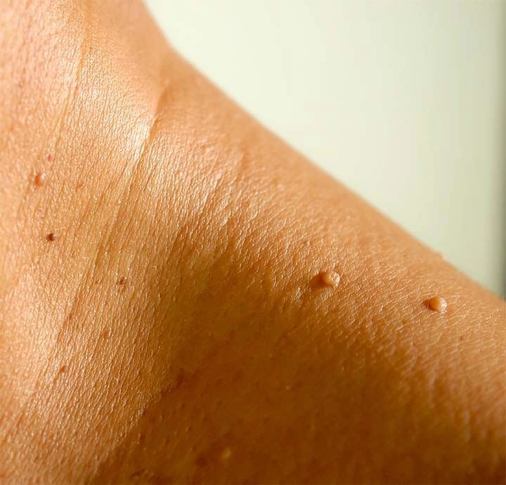 Skin Tag Removal