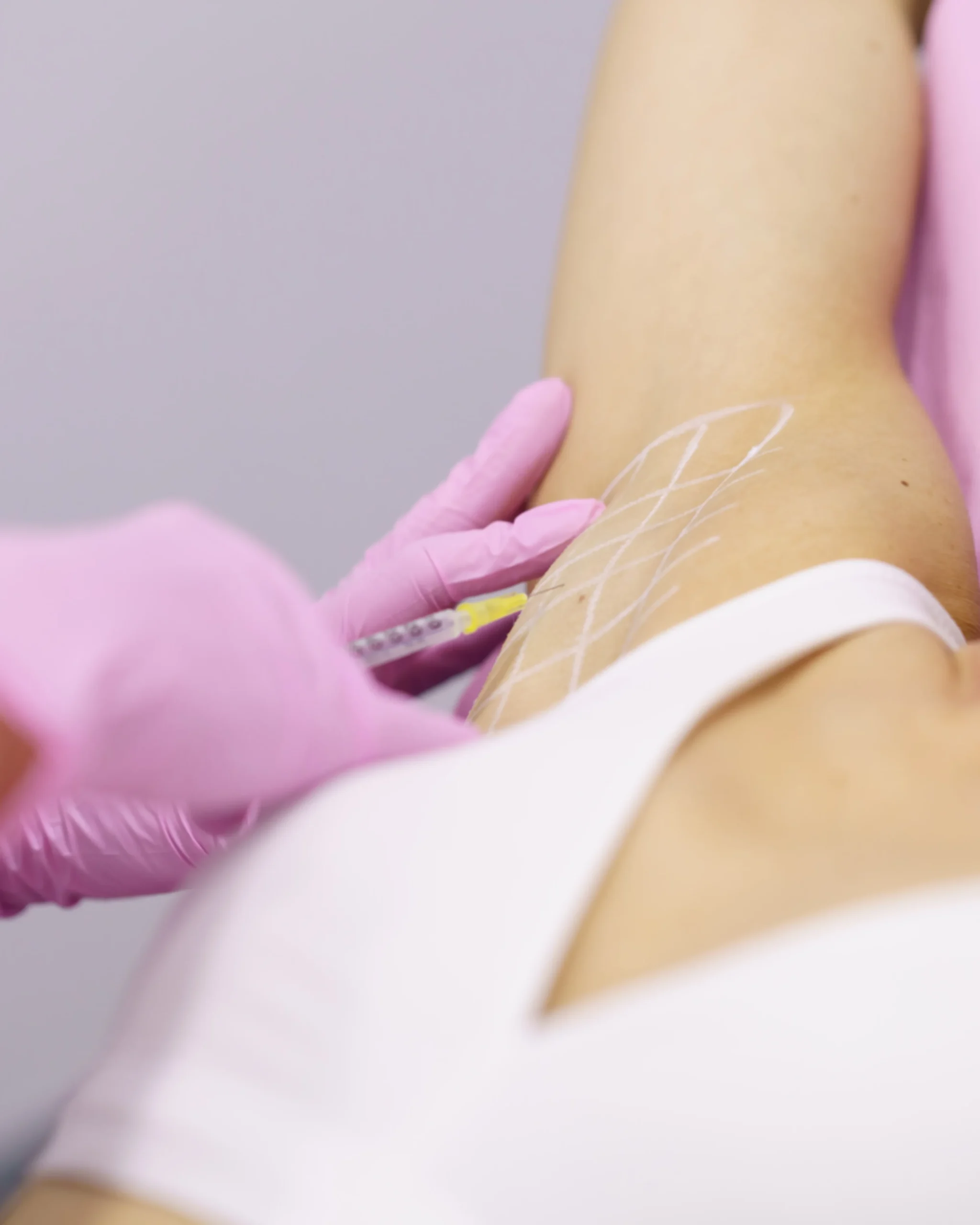 underarm botox