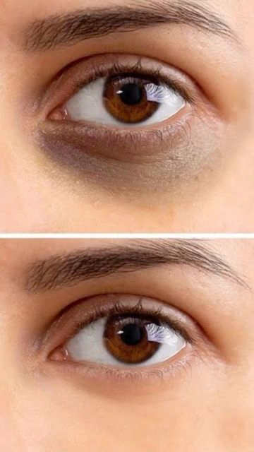 Dark Circles Under Eyes Treatment