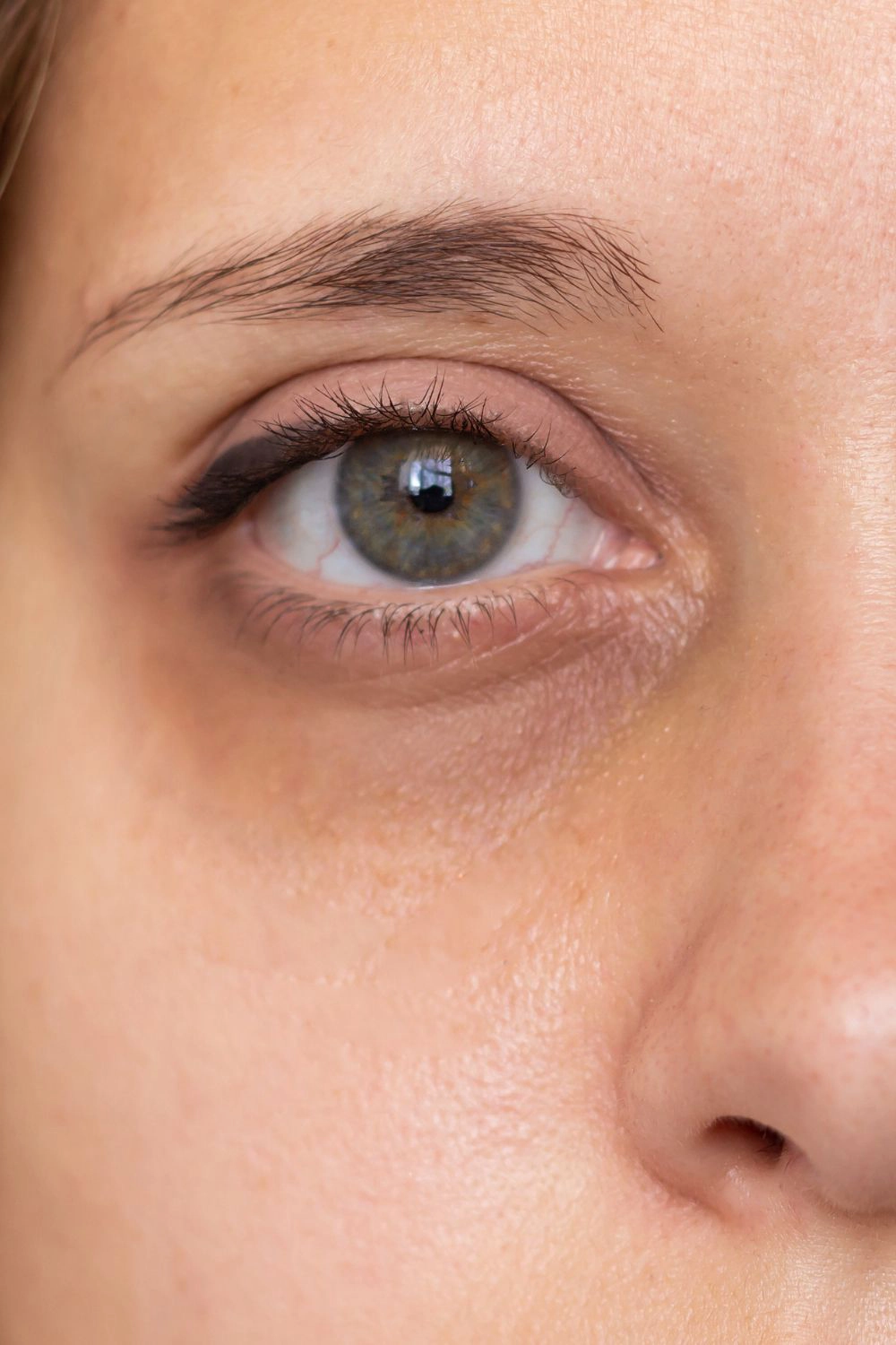 Dark Circles Under Eyes Treatment