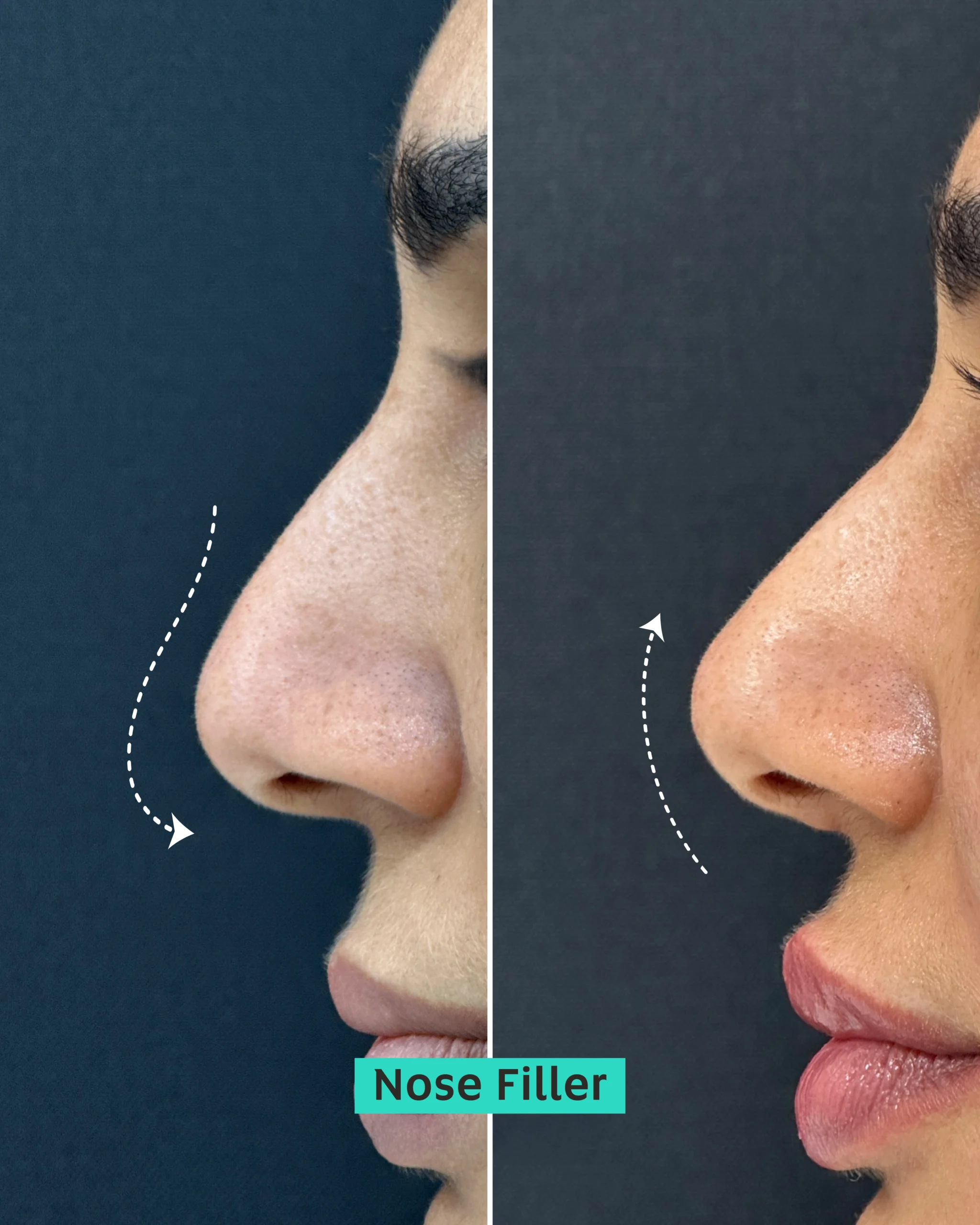 nose filler