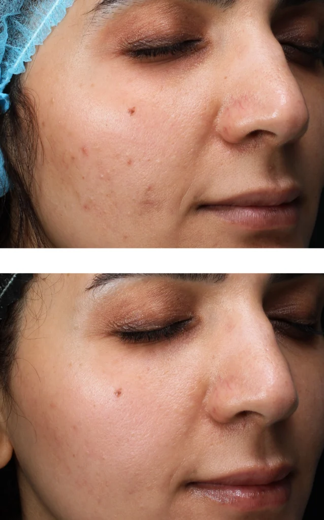 Snow white facial
